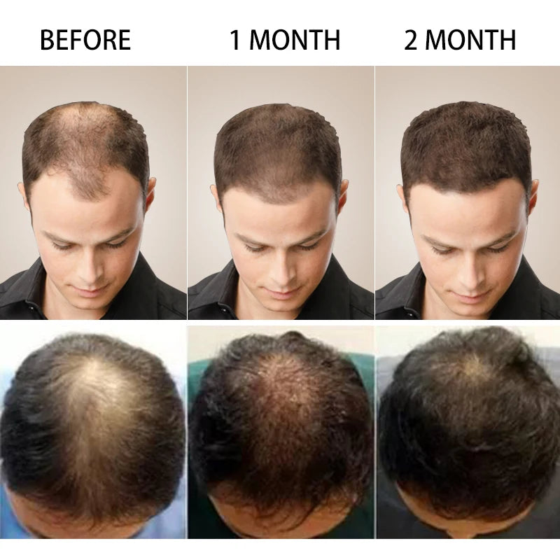  Hair Loss Oil for Men Women - Veer Beauty